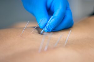 Acupuncture Oshawa