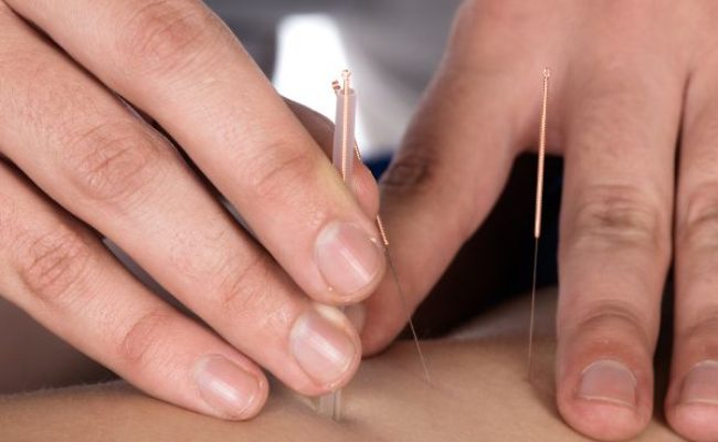 Acupuncture Oshawa Acupuncture Oshawa Our experienced physiotherapist trained in acupuncture applying targeted pressure at specific trigger points using acupuncture needles. Acupuncture is an ancient healing practice that involves inserting thin needles into strategic points of the body to promote pain relief, relaxation, and overall well-being. By applying acupuncture, our physiotherapist aims to stimulate the body's natural healing response, alleviate muscle tension, improve blood circulation, and reduce pain. At our clinic, we offer a comprehensive approach to physiotherapy, integrating acupuncture as a complementary treatment modality to help our patients achieve optimal results and enhance their overall recovery journey.
